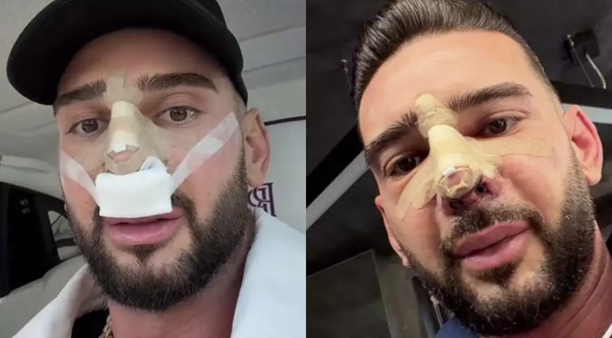 Cum arată nasul lui Dorian Popa la 12 zile de la operație. Și-a dat bandajul jos: „Cum nici nu am visat”