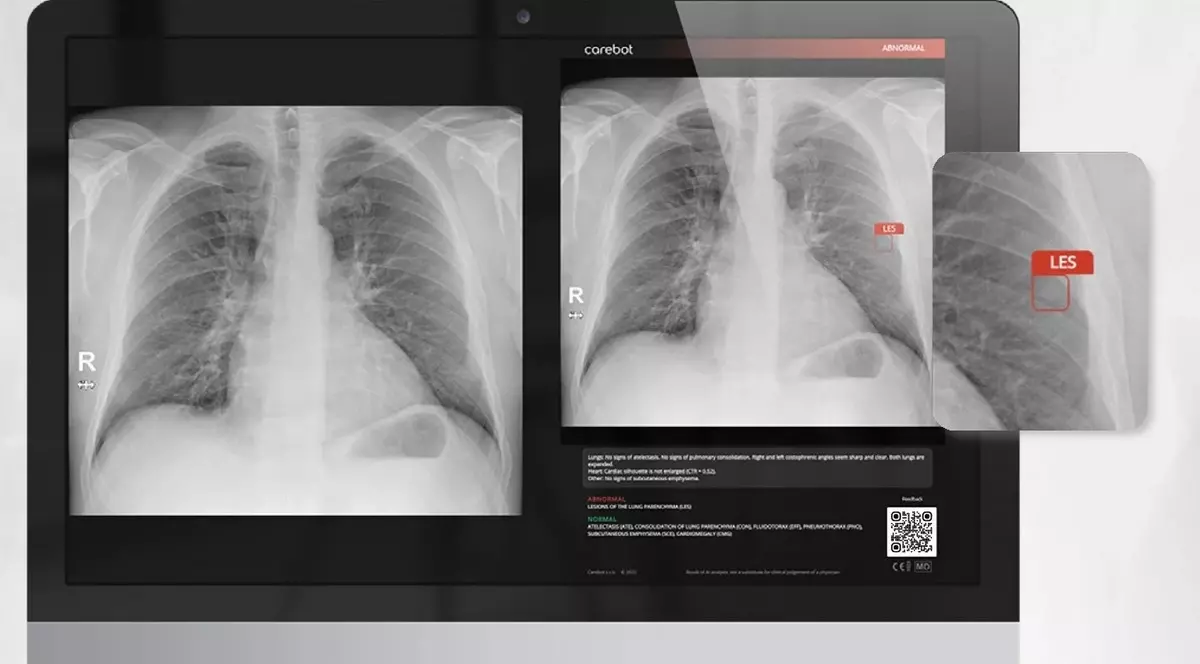 Revoluția silențioasă din radiologia pulmonară care salvează vieți în fiecare zi
