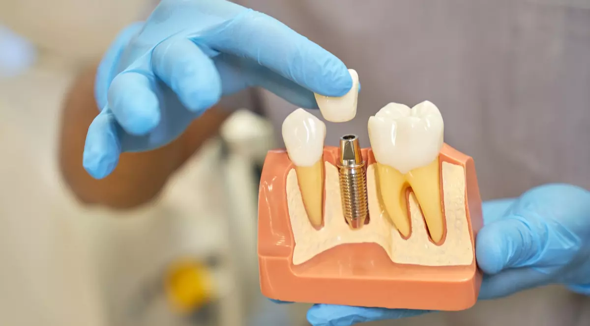 Implanturi dentare premium: Ce diferențiază tipurile de implant