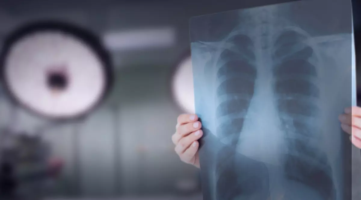 Un doctor care analizează o radiografie la plămâni.