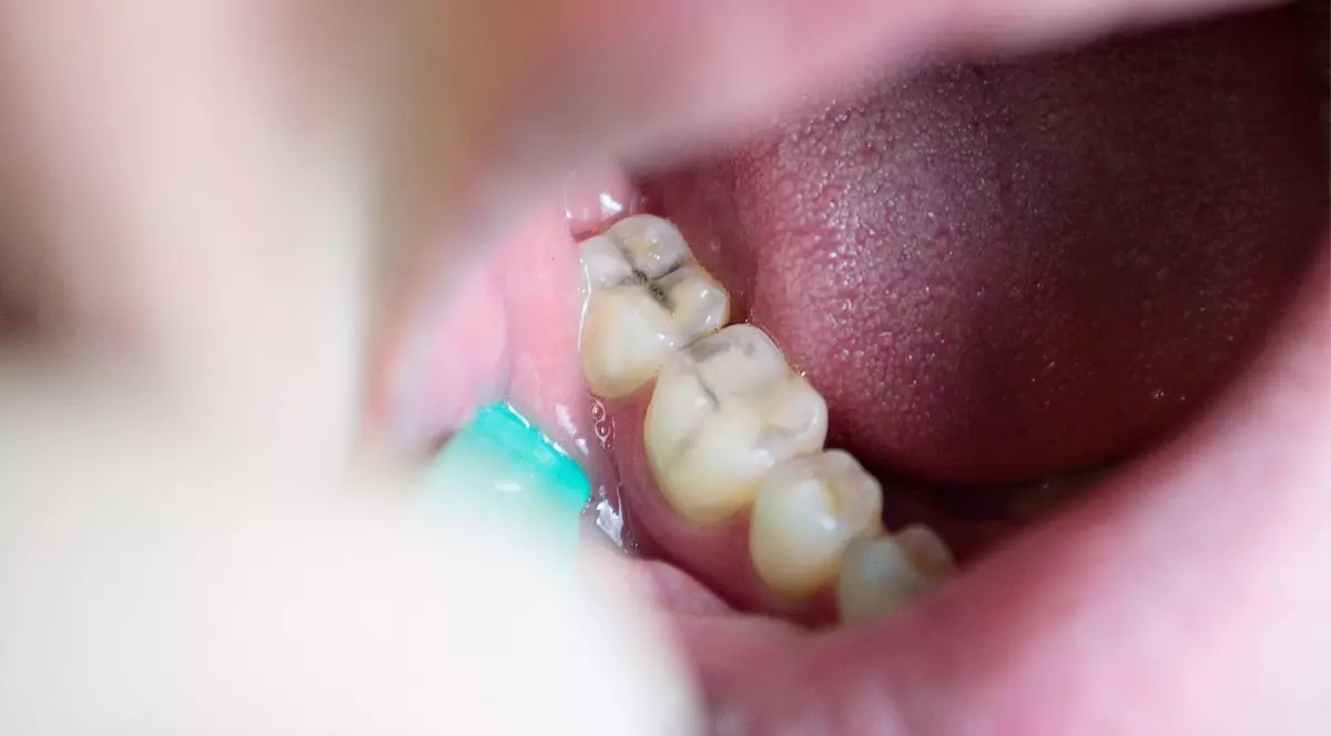 Revoluția Materialelor Ceramice în Estetica Dentară Modernă