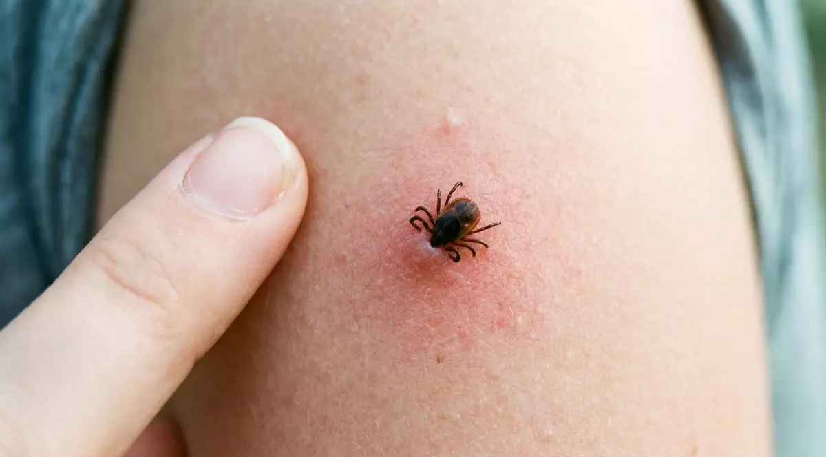 O persoană mușcată de o căpușă, insecta i-a rămas blocată în piele