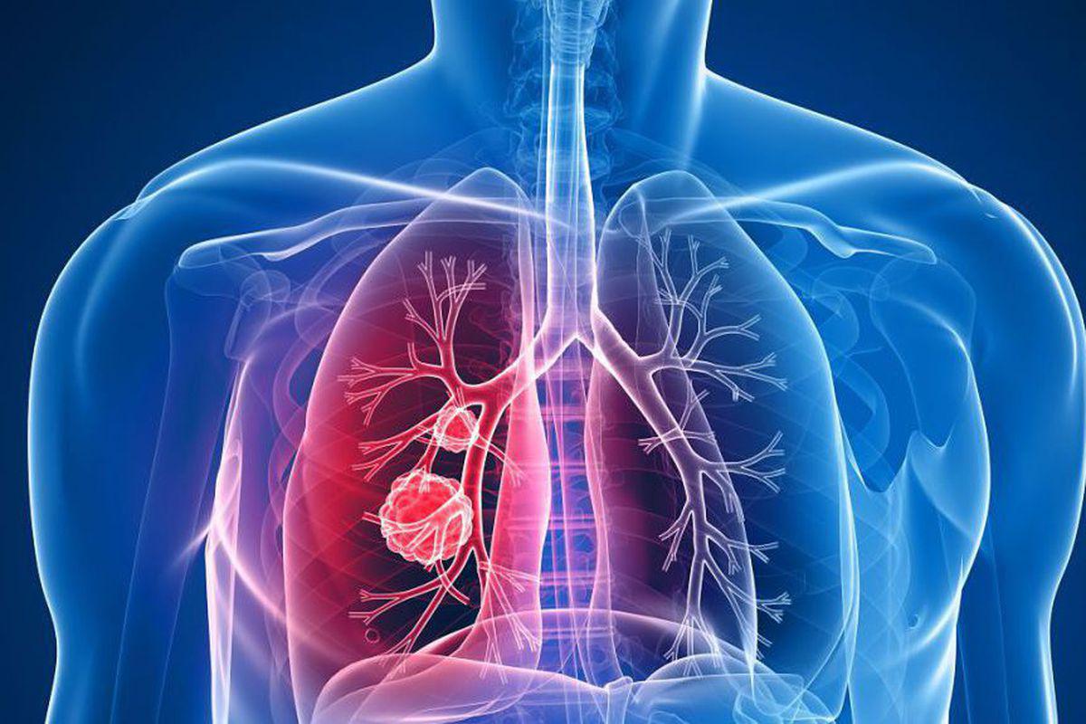 Simptomele Cancerului Pulmonar Boala Confundată Cu O Răceală