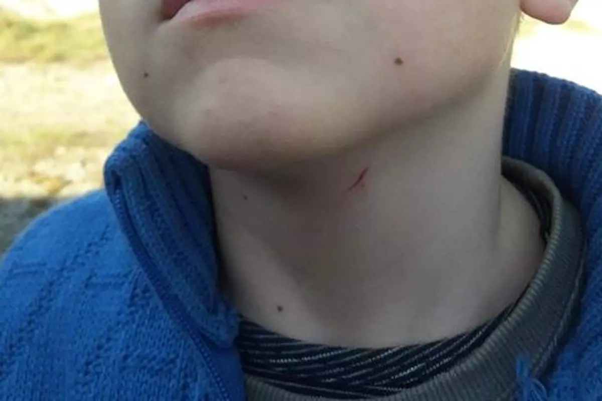 strâns în gât artrita reumatoida cronica