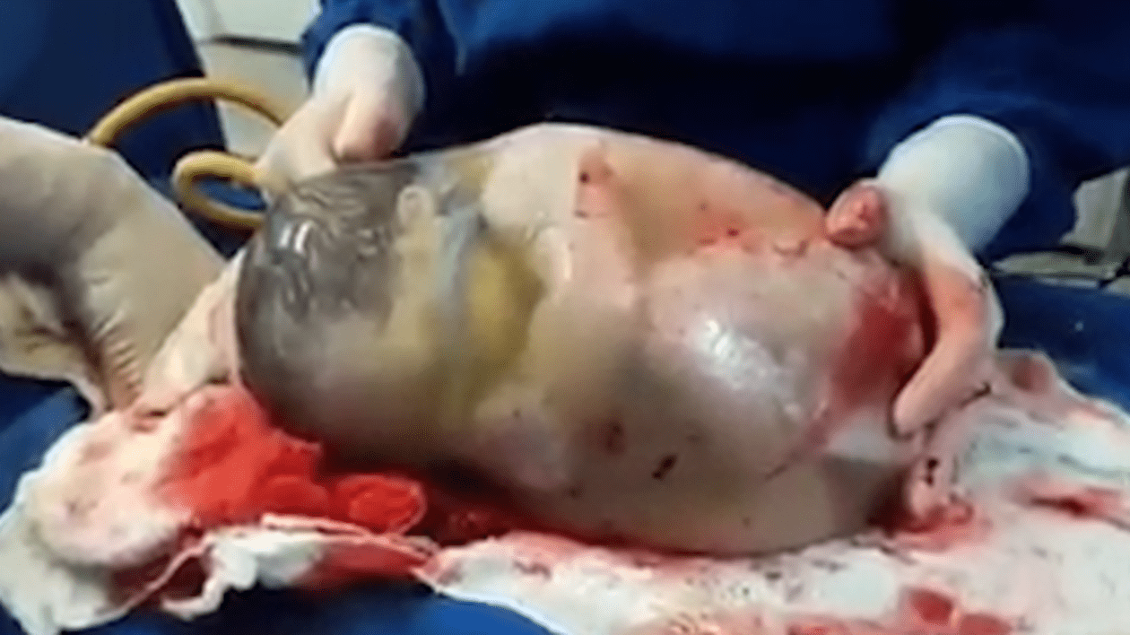 Momentul incredibil în care un bebeluş se naşte cu sacul amniotic intact | VIDEO