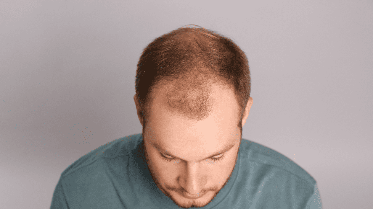 Alopecia - factori de risc, cauze și tratament. De ce chelesc bărbații