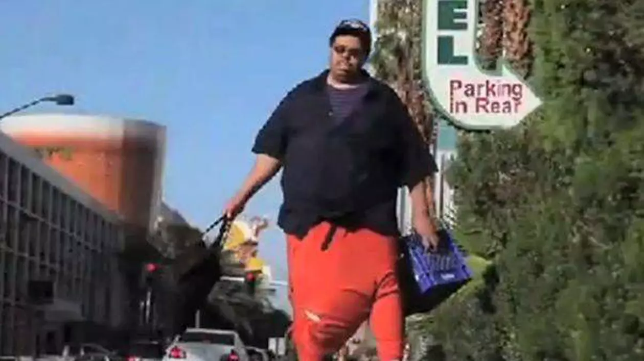 Bărbatul cu cel mai mare scrot din lume, de 45 de kilograme, s-a operat! | VIDEO
