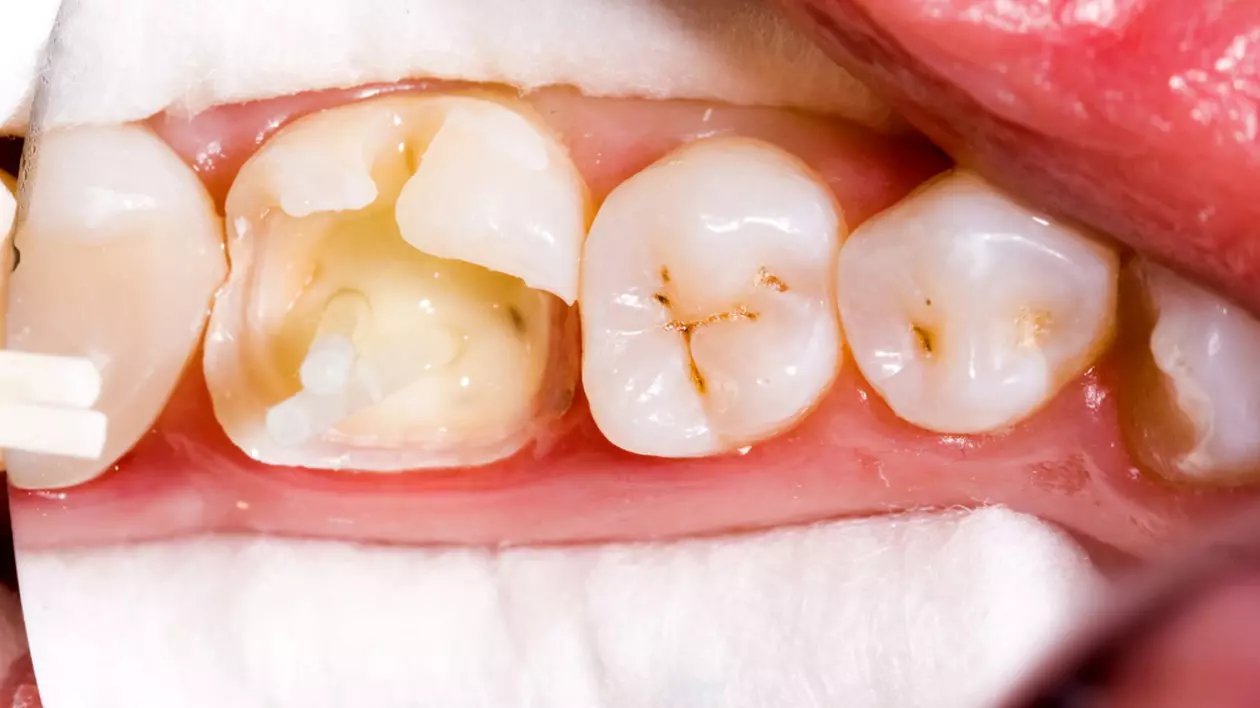 Cum să vindeci cariile dentare în mod natural