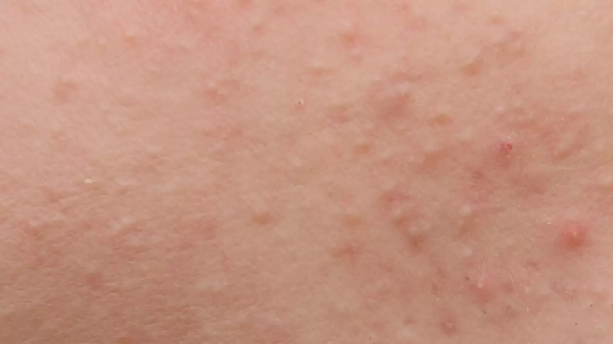 Află ce este keratosis pilaris și cum îți afectează pielea