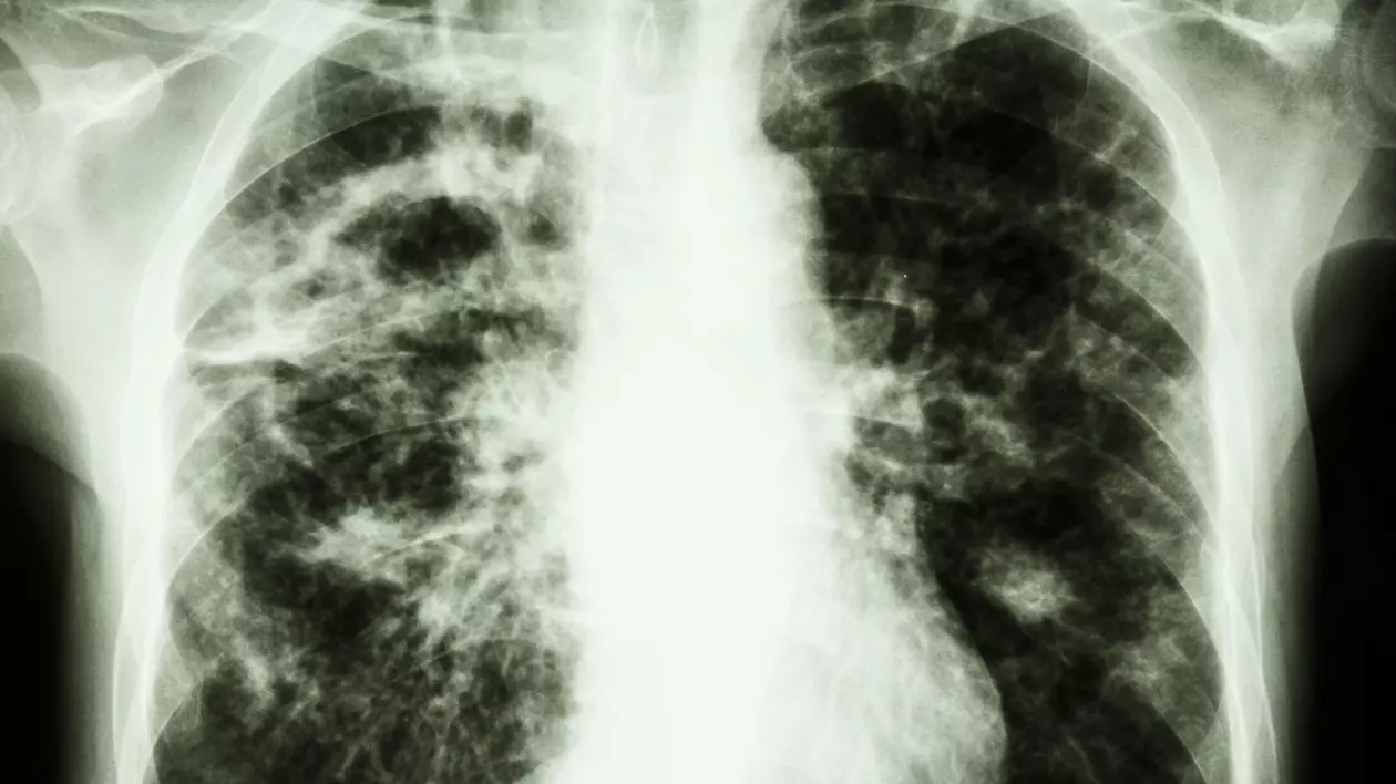 cele mai multe cazuri noi de tuberculoză înregistrate