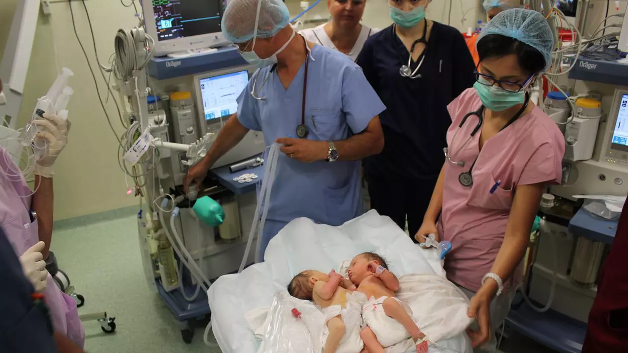 Siamezele de la Braşov, operate cu succes la Marie Curie