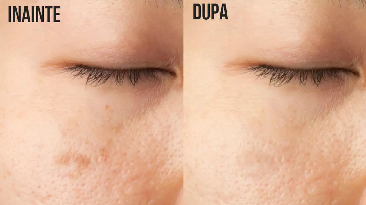Cum scapi de petele de pe faţă în mod natural
