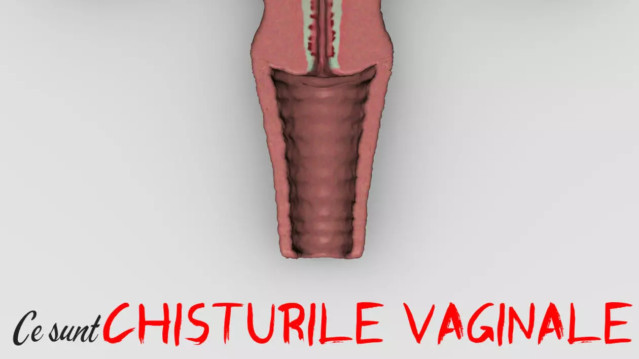 Ce sunt chisturile vaginale și cum îți dai seama dacă ai și tu