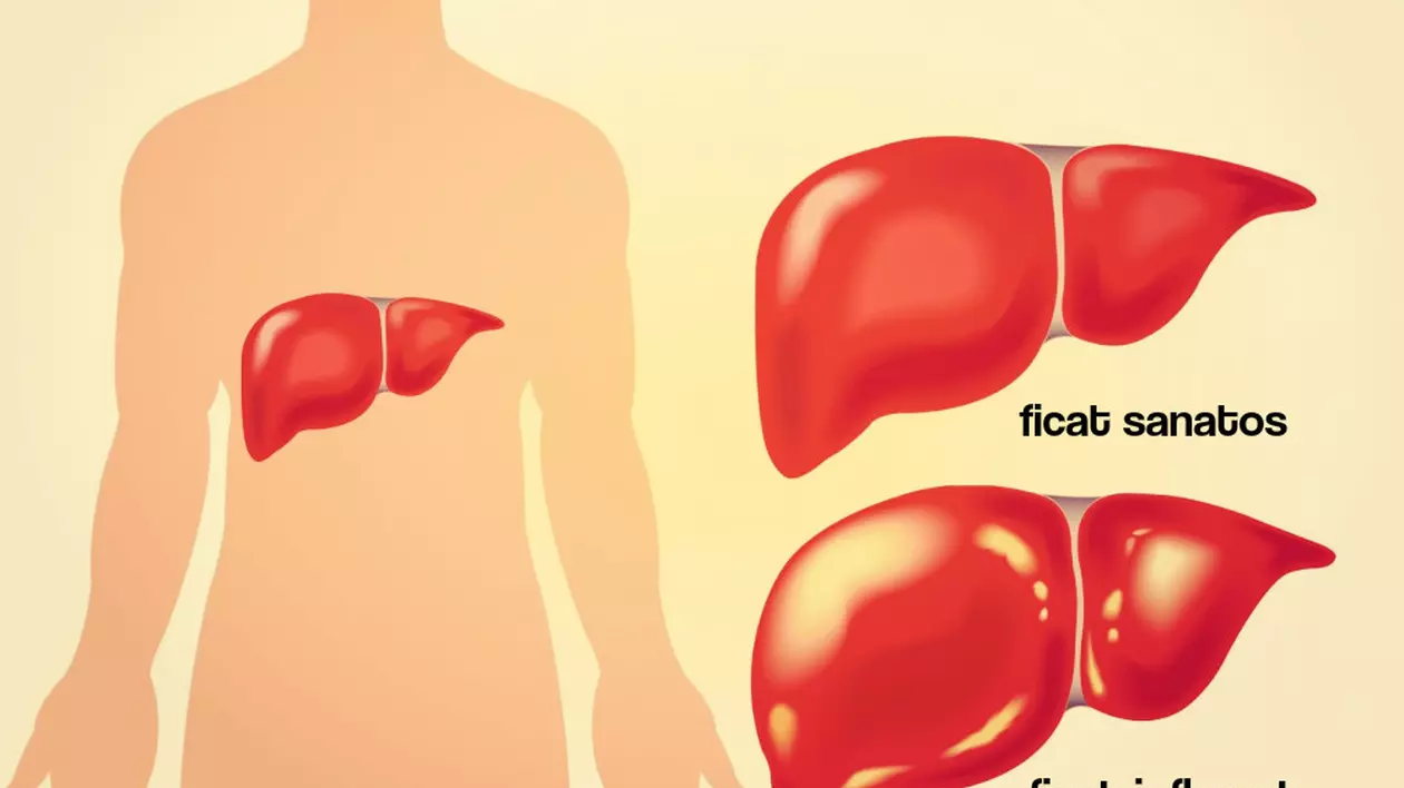 Totul despre hepatita B – prevenţie, simptome tratament