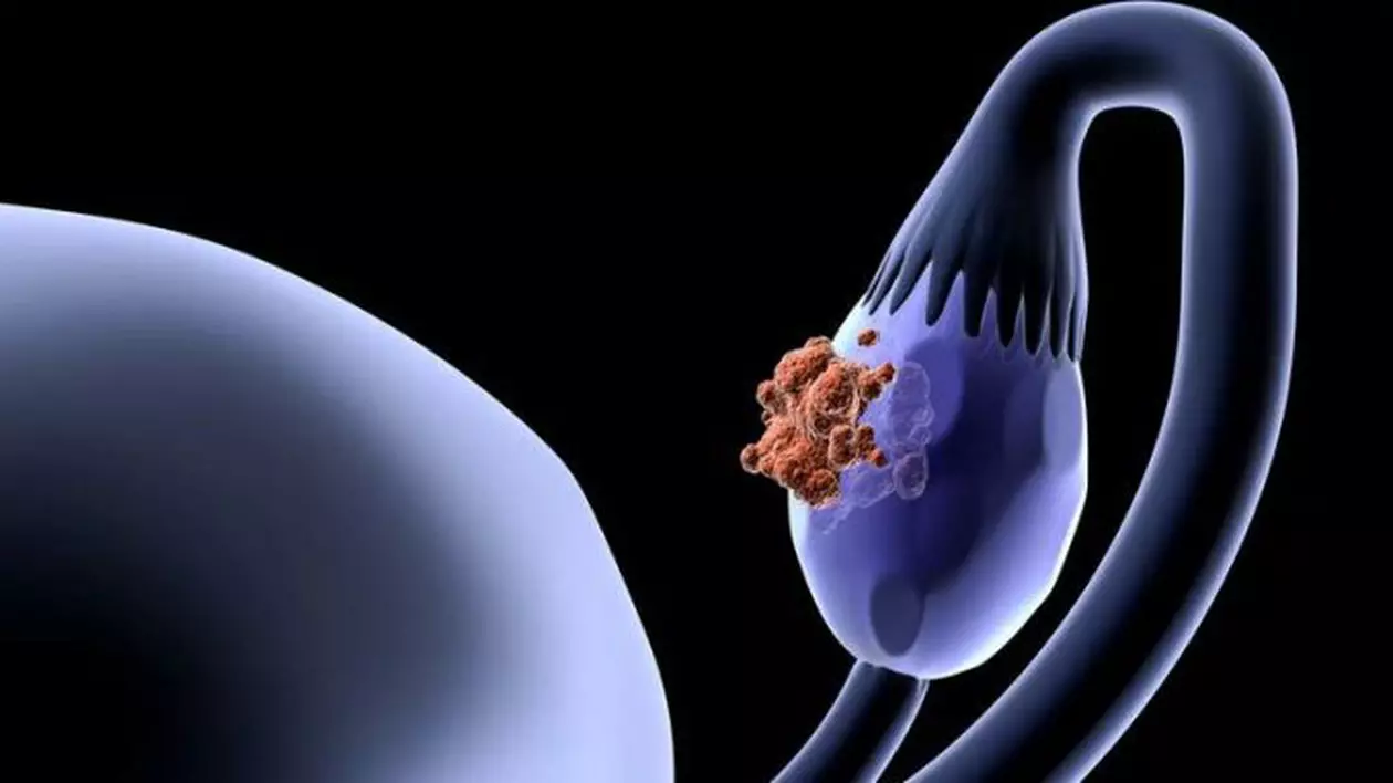 Aceste informații despre CANCERUL OVARIAN vă pot salva viața