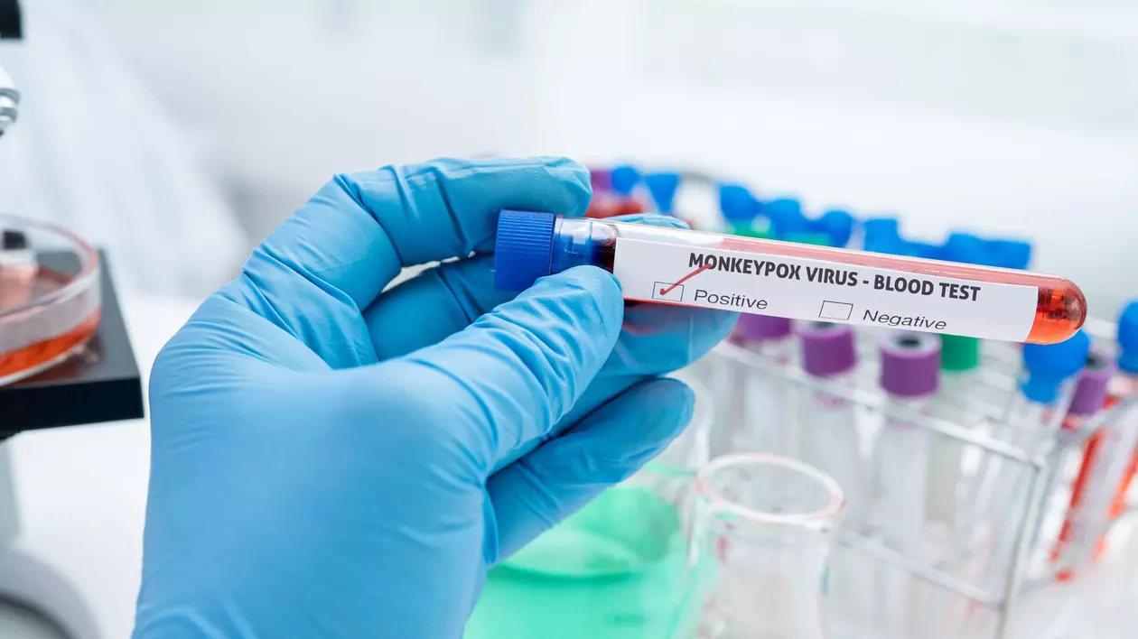 Un italian este primul om din lume depistat pozitiv cu COVID, HIV şi variola maimuţei, în același timp