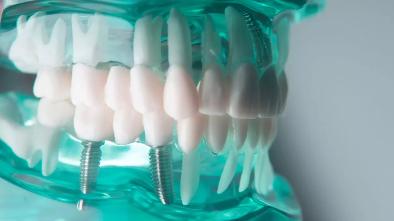 Implant Studio - Zâmbete perfecte fără durere