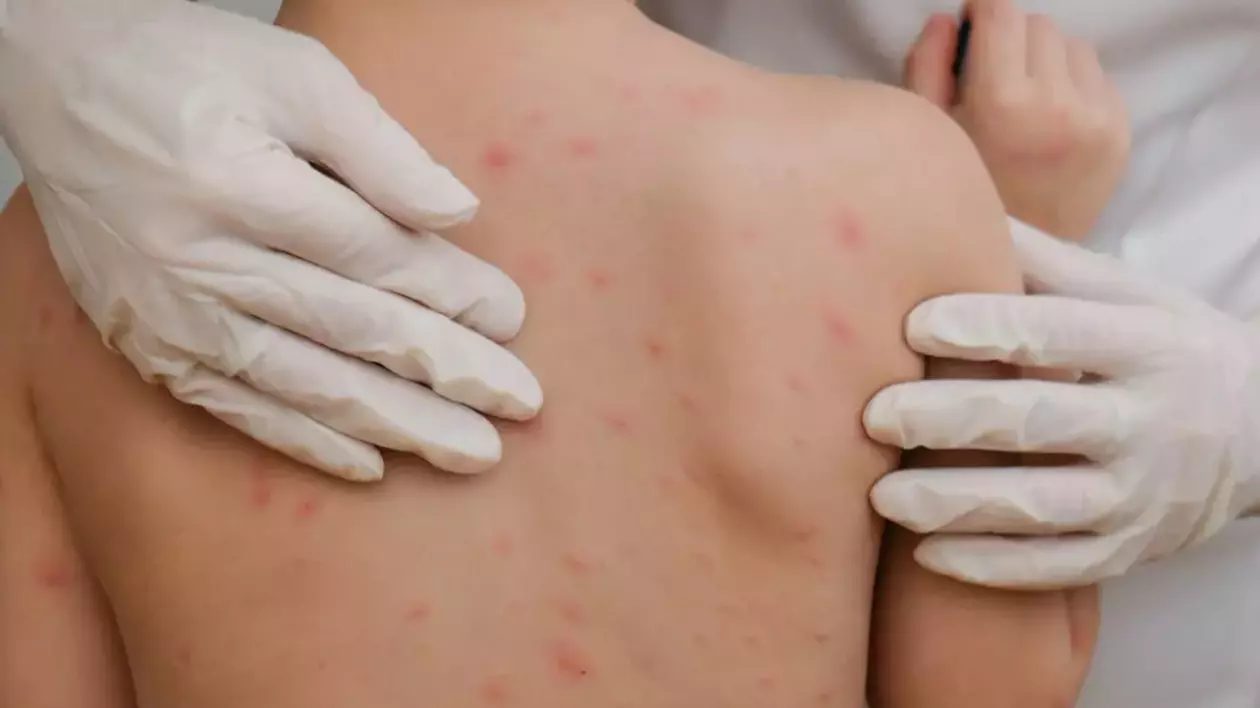 Un copil de 10 luni din București a murit de rujeolă: era nevaccinat. Câte cazuri s-au înregistrat în ultima săptămână