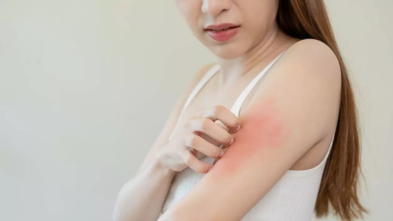 Remedii eficiente pentru alergia la soare - ce este alergia la soare