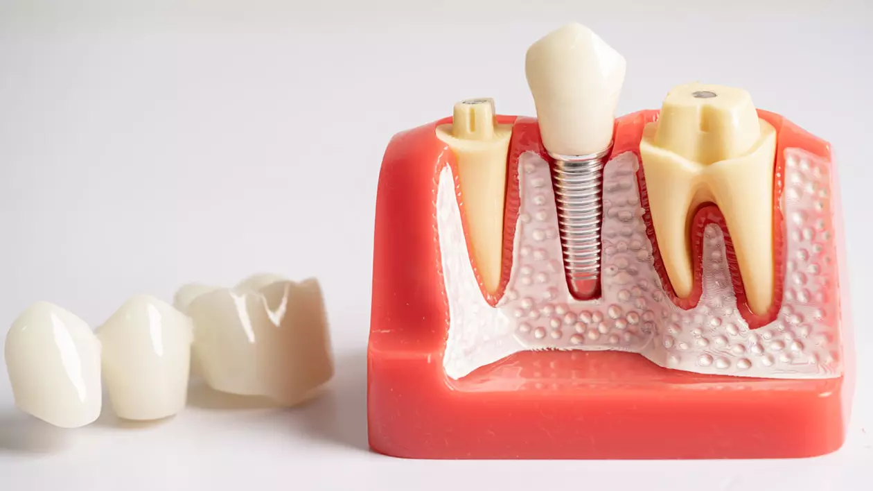 Avantajele implantului dentar: care sunt beneficiile?