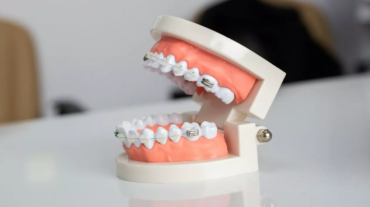Cât costă un aparat dentar și cum alegi varianta potrivită pentru tine