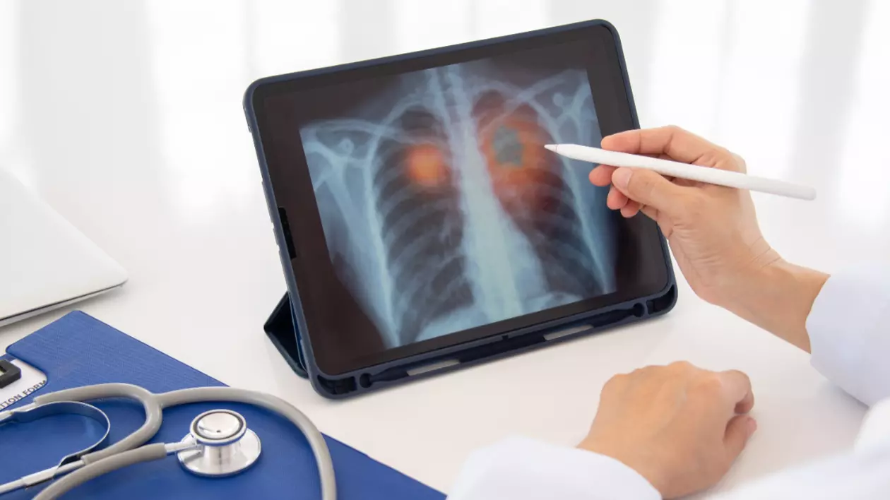 În imagine este prezentată o radiografie pulmonară