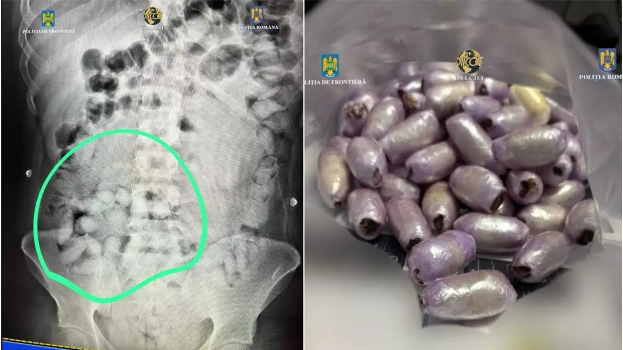 „Formaţiuni neobişnuite” care se văd în stomacul brazilianului la controlul cu scanner cu raze X și capsulele de cocaină