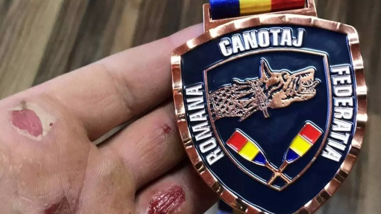 Mâna campionului la canotaj Ciprian Tudosă, palmele au vânătăi, bășici și răni deschise. În mână ține o medalie pe care scrie Federația Română de Canotaj.