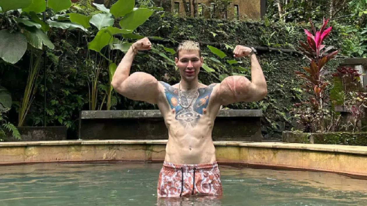 „Popeye”, influencerul care și-a injectat ulei în brațe ca să impresioneze pe net, a ajuns la spital: „Operație de îndepărtare a bicepșilor”