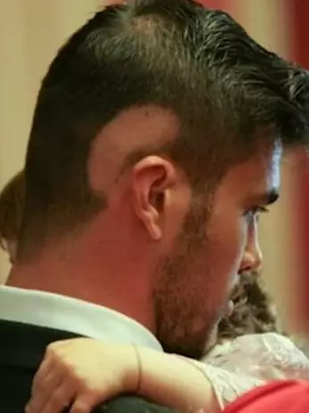 marius-elisei-alopecie