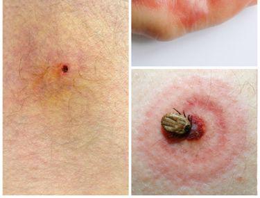 Cum Iţi Dai Seama Ce Insectă Te A Muscat Lifestyle Sănătate și Fitness Libertatea Libertatea