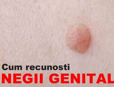 Cum știi Că Ai Negi Genitali Lifestyle Sănătate și Fitness