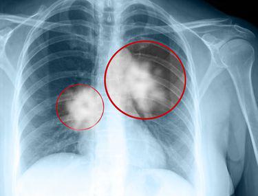 Simptome Mai Puţin Cunoscute Ale Cancerului Pulmonar Lifestyle Sănătate și Fitness Libertatea Libertatea