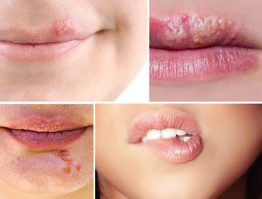 Cum Iţi Dai Seama Dacă Ai Herpes Sau Zona Zoster Lifestyle