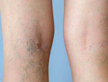 Tratamentul corect pentru varicele picioarelor cu oțet de mere - Tromboflebită August