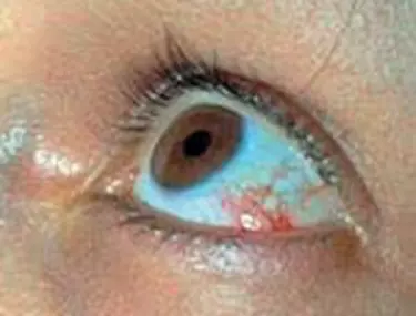 scăderea acuității vizuale ochi roșii cum îți poți crește vederea