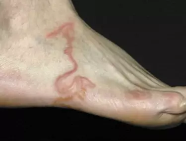 simptome varicoza picior