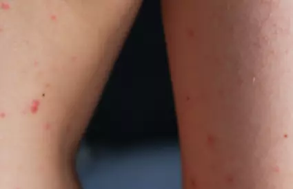 ALERTĂ în România! Numărul de cazuri a crescut la... Vezi mai mult