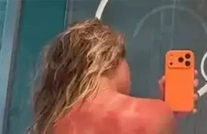 Renata Zarazúa s-a dezbrăcat pentru a-și arăta pielea arsă. Avertisment dur pentru cei care merg la Australian Open