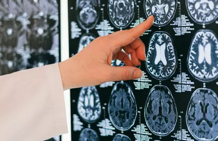 Forma creierului poate trăda instalarea demenței