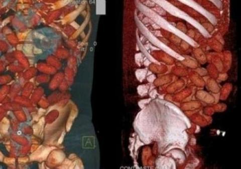 Iată cum arată 72 de capsule cu cocaină ascunse în stomac