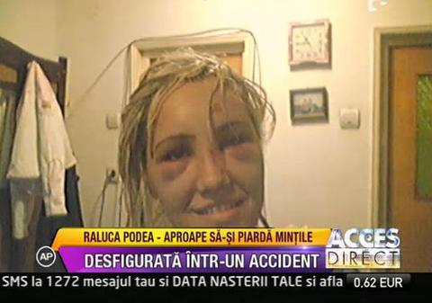 Raluca Podea a fost desfigurată într-un accident rutier | FOTO