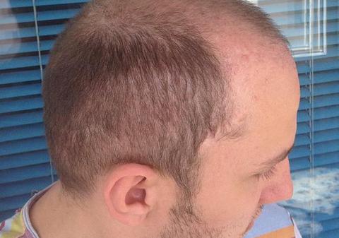 Drama lui Trăistariu, după operaţia de implant de păr: "A căzut APROAPE TOT" FOTO