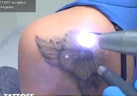 SUPER FAZĂ! O să rămâi uluit când o să vezi cum se şterg tatuajele cu laser | VIDEO