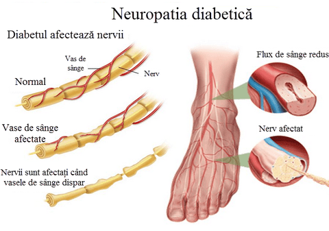 (P) Neuropatia diabetică în medicina chinezească