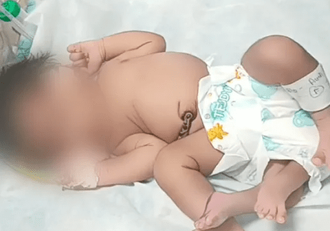 O femeie din India a născut un copil cu patru picioare. Ce decizie au luat medicii