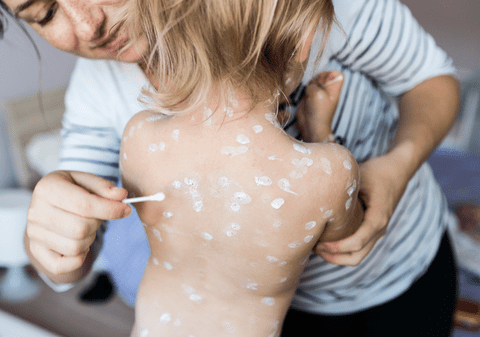 Val de cazuri de varicelă la adulți în 2026. De ce boala „copilăriei” a devenit un pericol letal la maturitate