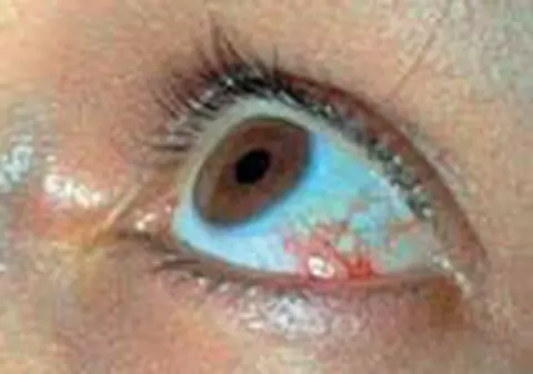OCHII ROSII POT ASCUNDE INFECTII HERPETICE