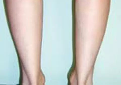 Picioare perfecte cu ajutorul silicoanelor