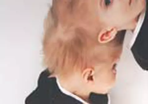 Siamezele, 10 ore sub anestezie